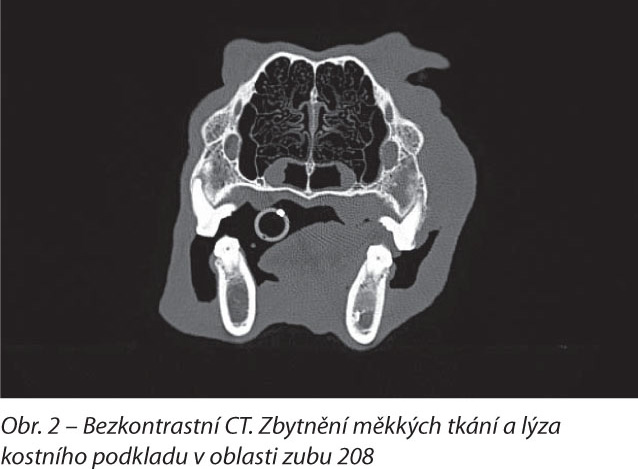 Bezkontrastní CT. Zbytnění měkkých tkání a lýza kostního podkladu v oblasti zubu 208