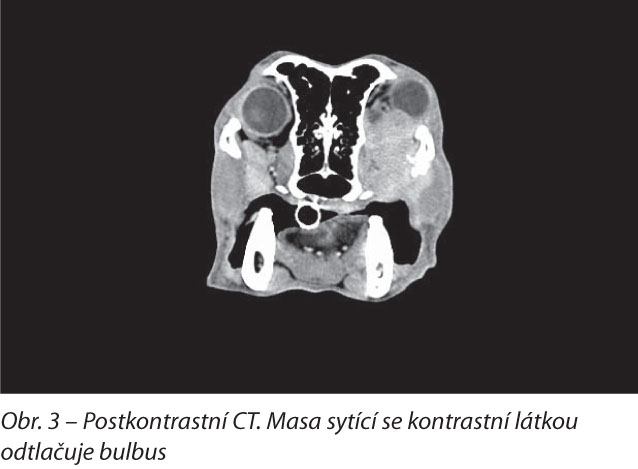 Postkontrastní CT. Masa sytící se kontrastní látkou odtlačuje bulbus