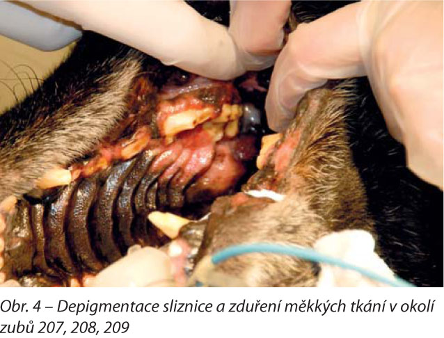 Depigmentace sliznice a zduření měkkých tkání v okolí zubů 207, 208, 209