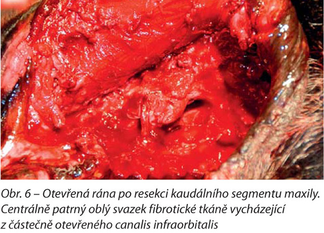 Otevřená rána po resekci kaudálního segmentu maxily. Centrálně patrný oblý svazek fibrotické tkáně vycházející z částečně otevřeného canalis infraorbitalis