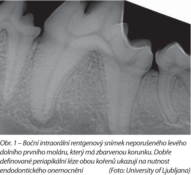 Boční intraorální rentgenový snímek neporušeného levého dolního prvního moláru, který má zbarvenou korunku. Dobře definované periapikální léze obou kořenů ukazují na nutnost endodontického onemocnění