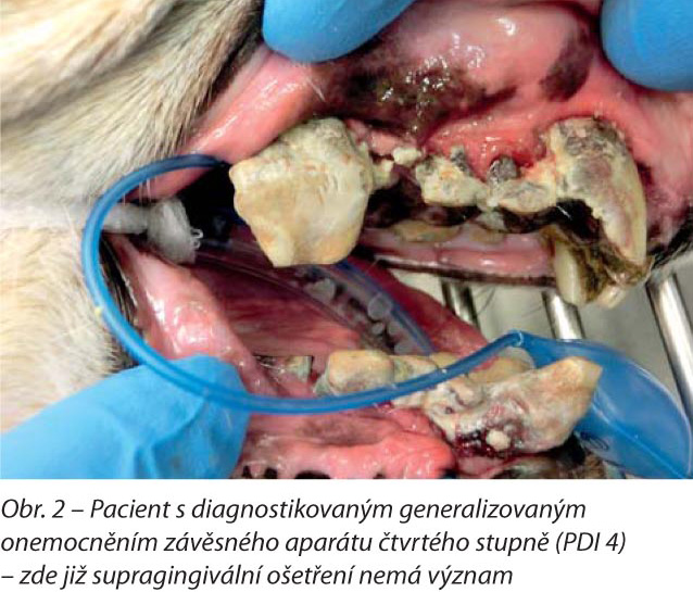 Pacient s diagnostikovaným generalizovaným onemocněním závěsného aparátu čtvrtého stupně (PDI 4) – zde již supragingivální ošetření nemá význam