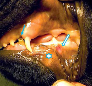 Modrá šipka: odhalená nekrotická zubní dřeň, modrobílá šipka: fistulace periapikální zánětlivé reakce, hvězdička: orientačně místo uložení kořene dočasného špičáku