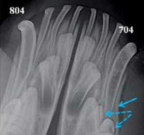 Intraorální RTG snímek pacienta č. 1: modrá plná šipka ukazuje na počínající resorpci kořene. Jako náhodný nález je modrými přerušovanými šipkami označen zdvojený trvalý zub 305