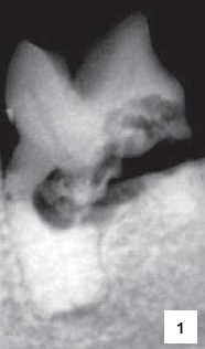 RTG snímek mandibulárního moláru s resorpční lézí typu I