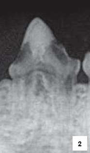 RTG snímek třetího mandibulárního premoláru s resorpční lézí typu II