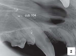 Obr. 2 – Maxilární špičáky poškozené atricí (na snímku jsou patrné artefakty z důvodu potřísnění rtg. fólie krví)