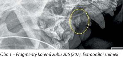 Fragmenty kořenu zubu