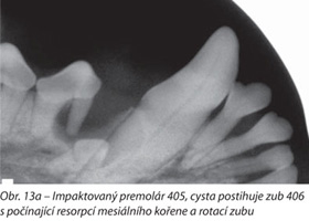 Impaktovaný premolár 405, cysta postihuje zub 406 s počínající resorpcí mesiálního kořene a rotací zubu