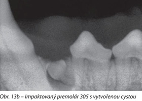 Impaktovaný premolár 305 s vytvořenou cystou