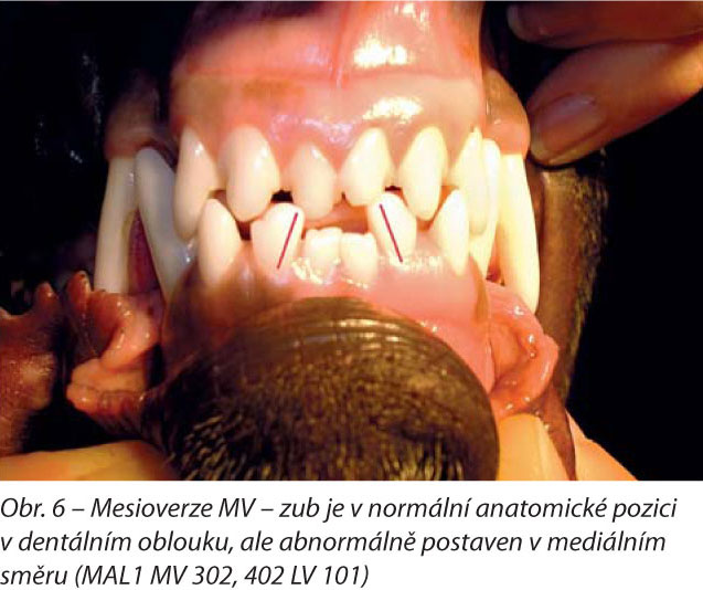 Mesioverze MV – zub je v normální anatomické pozici v dentálním oblouku, ale abnormálně postaven v mediálním směru (MAL1 MV 302, 402 LV 101)