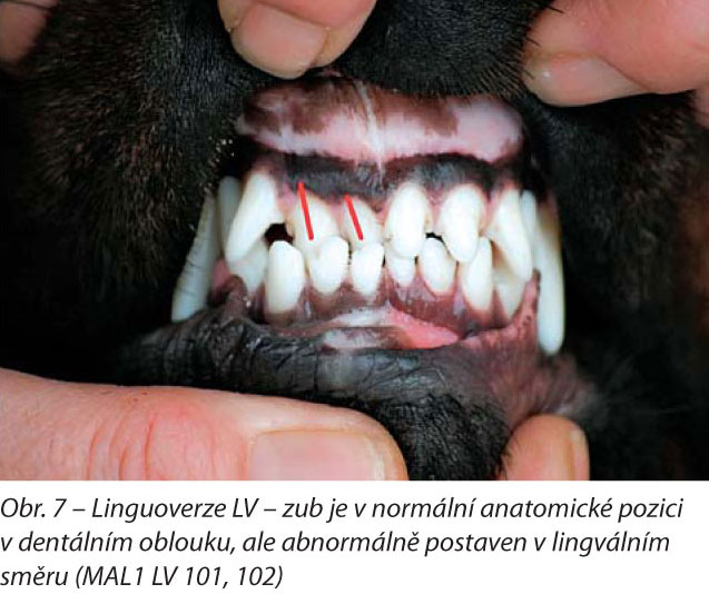 Linguoverze LV – zub je v normální anatomické pozici v dentálním oblouku, ale abnormálně postaven v lingválním směru (MAL1 LV 101, 102)