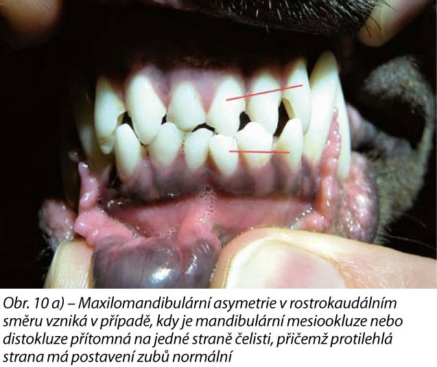 Obr. 10 a) – Maxilomandibulární asymetrie v rostrokaudálním směru vzniká v případě, kdy je mandibulární mesiookluze nebo distokluze přítomná na jedné straně čelisti, přičemž protilehlá strana má postavení zubů normální