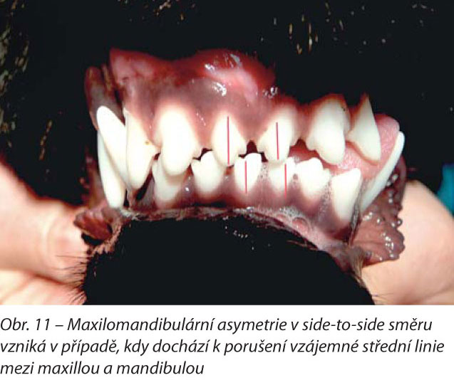 Maxilomandibulární asymetrie v side-to-side směru vzniká v případě, kdy dochází k porušení vzájemné střední linie mezi maxillou a mandibulou