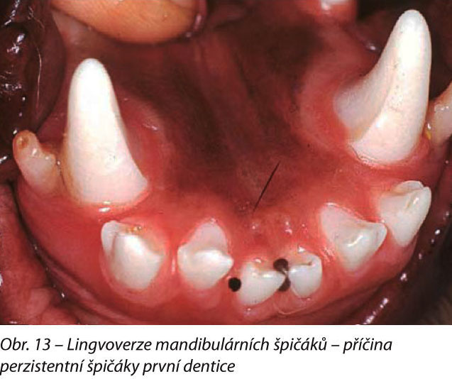 Lingvoverze mandibulárních špičáků – příčina perzistentní špičáky první dentice